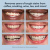 Auraglow Teeth Whitening Pen