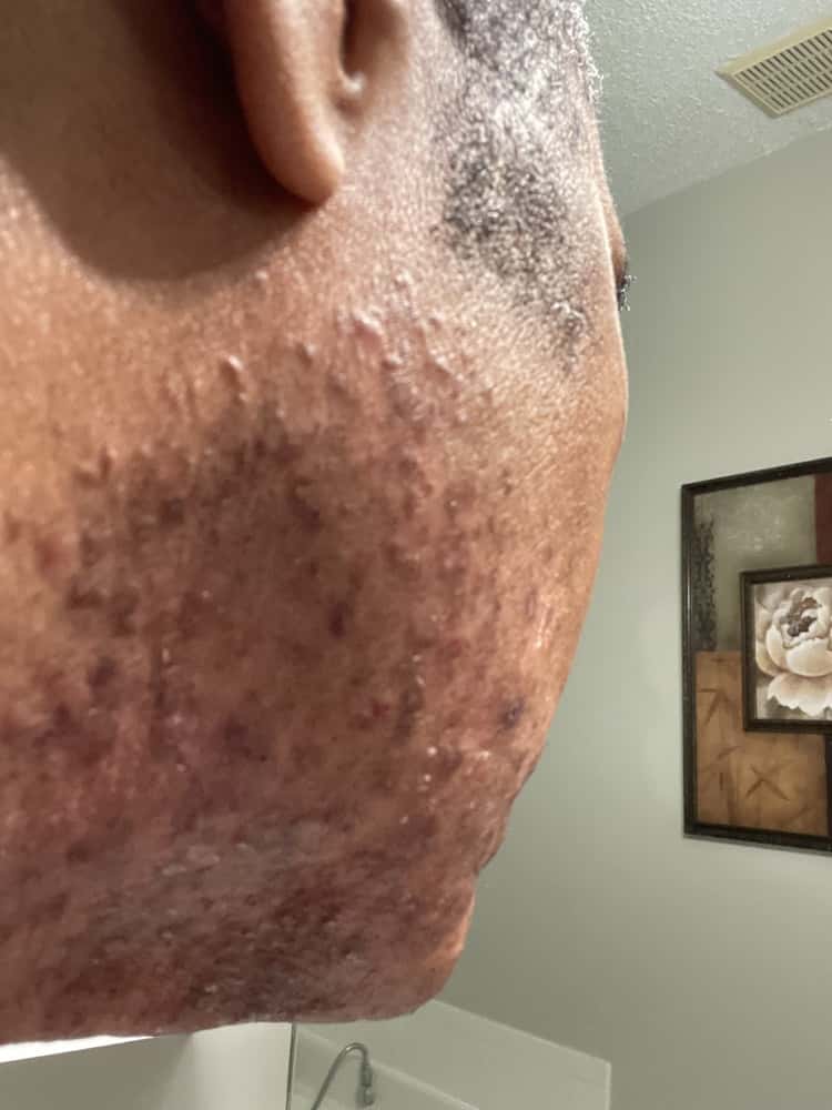 Bernard before using FLEX