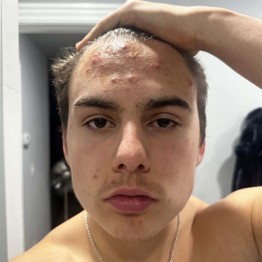 Kadin before using FLEX