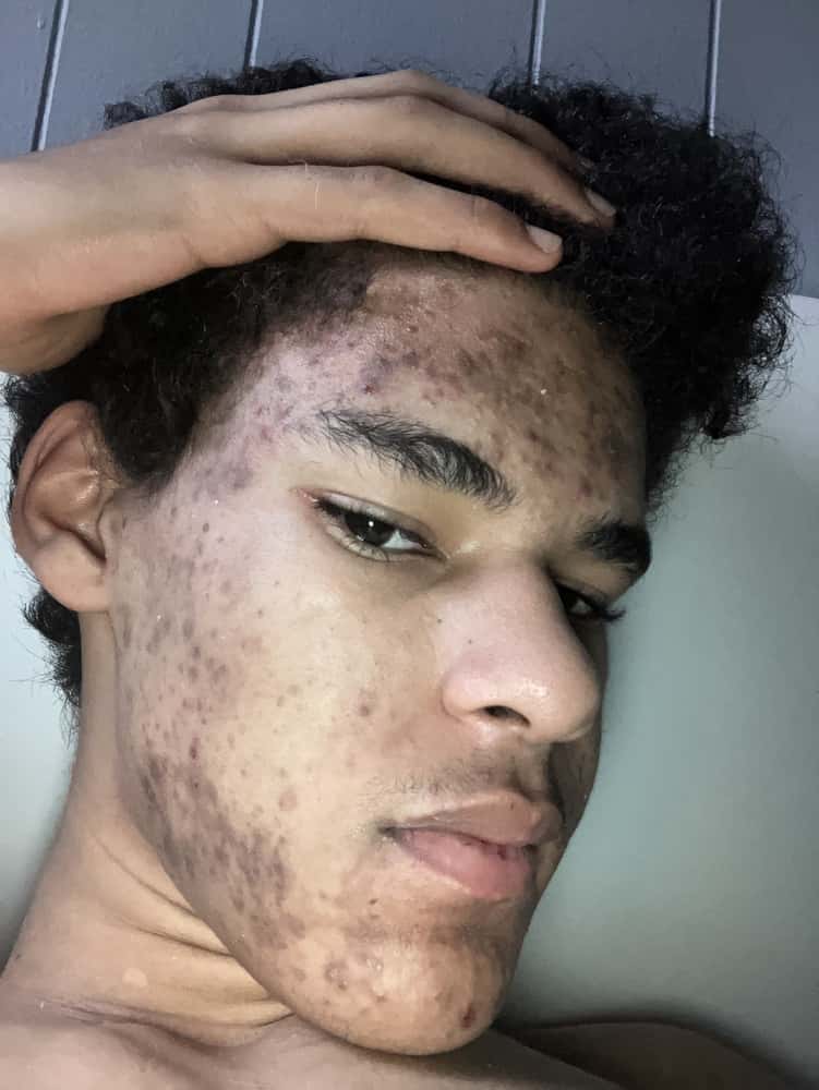 Tevvon before using FLEX