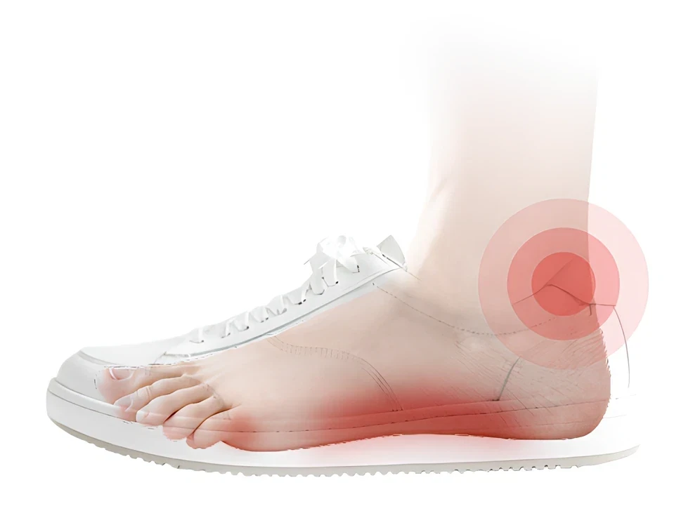 Foot inside a conventional shoe, with pain highlighted at the heel and under the arch