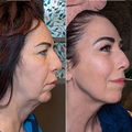 RenewaLift: The Vertical Lip Line Specialist - image 6