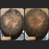 SPARTAN™ Root Activator Shampoo - Increased Hair Growth with Just 4 Washes a Week*